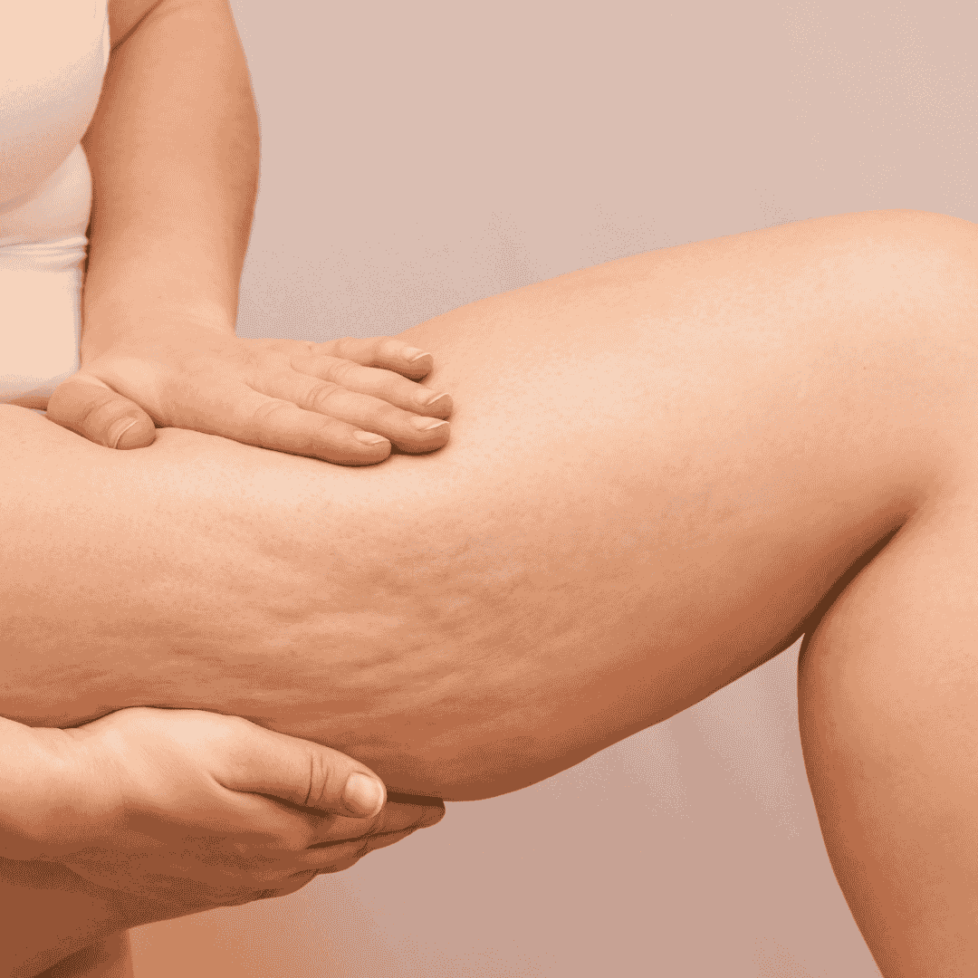 Celulitis